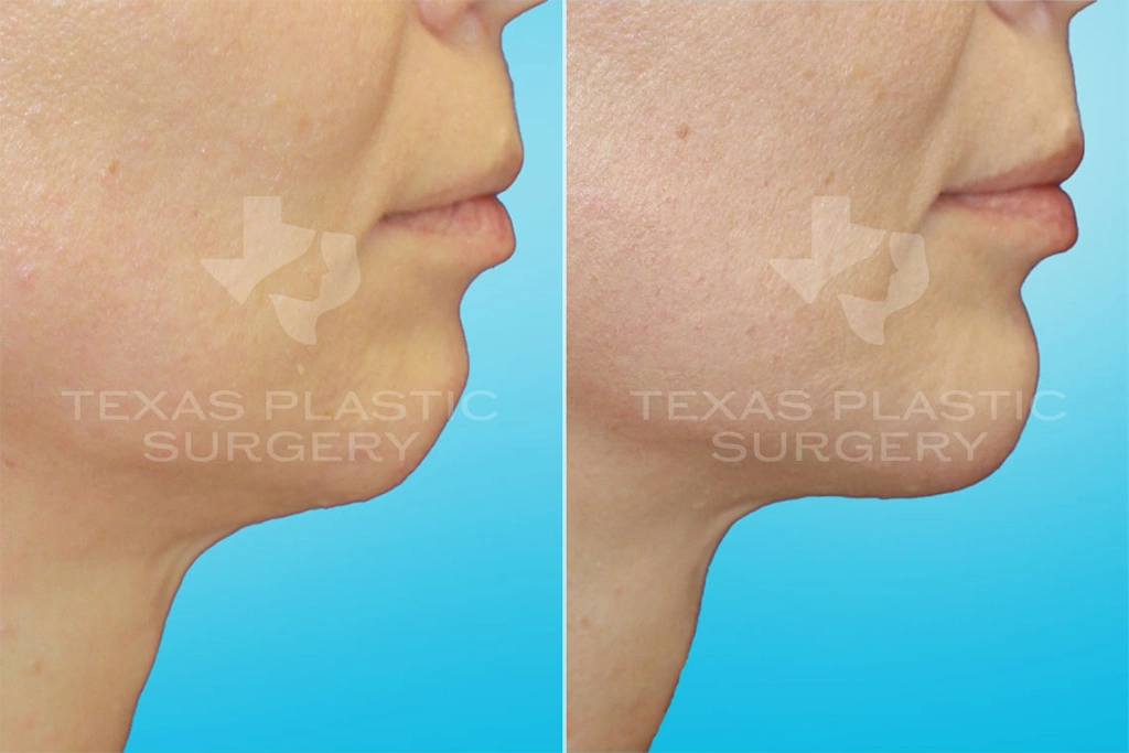 Real Patient results in San Antonio, TX Performed by Texas Plastic Surgery