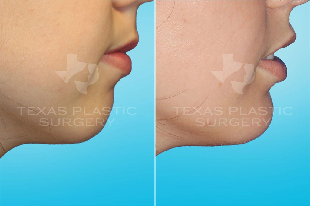 Real Patient results in San Antonio, TX Performed by Texas Plastic Surgery