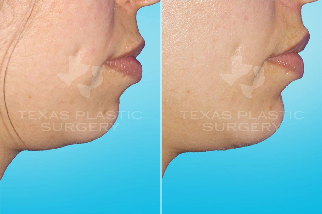 Real Patient results in San Antonio, TX Performed by Texas Plastic Surgery