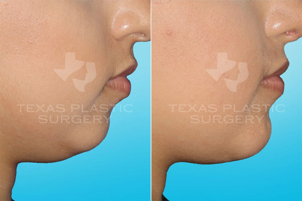 Real Patient results in San Antonio, TX Performed by Texas Plastic Surgery