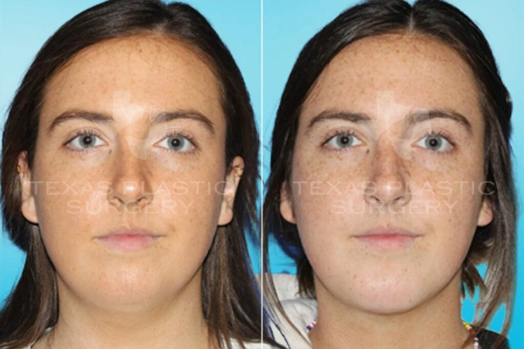 Real Patient results in San Antonio, TX Performed by Texas Plastic Surgery