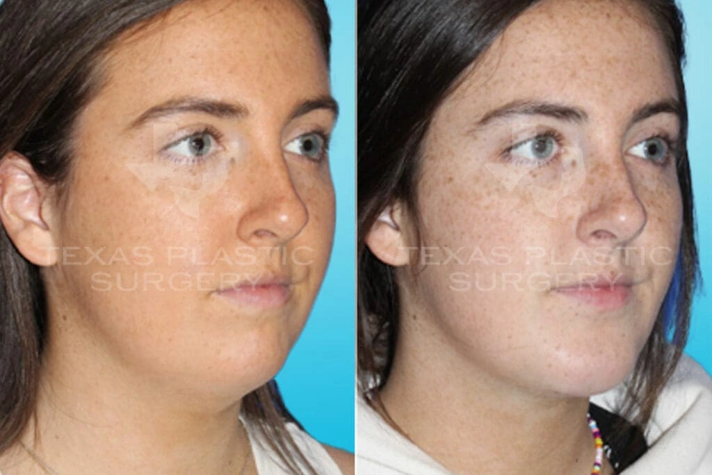 Real Patient results in San Antonio, TX Performed by Texas Plastic Surgery