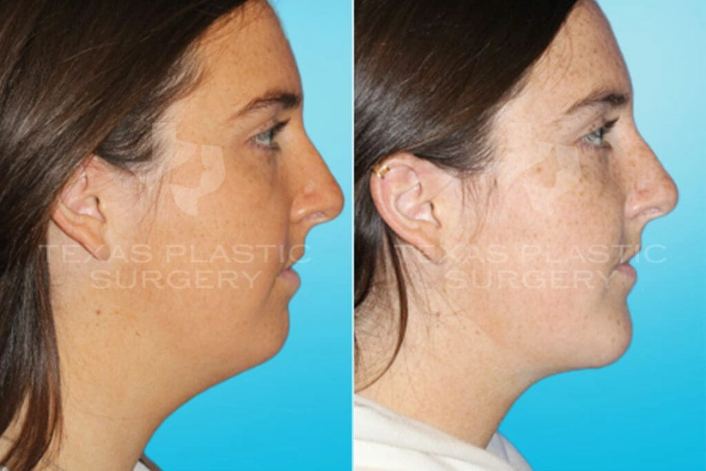 Real Patient results in San Antonio, TX Performed by Texas Plastic Surgery