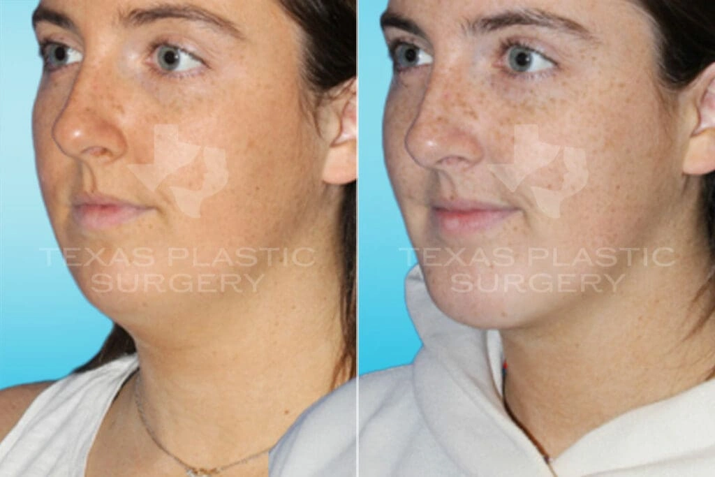 Real Patient results in San Antonio, TX Performed by Texas Plastic Surgery