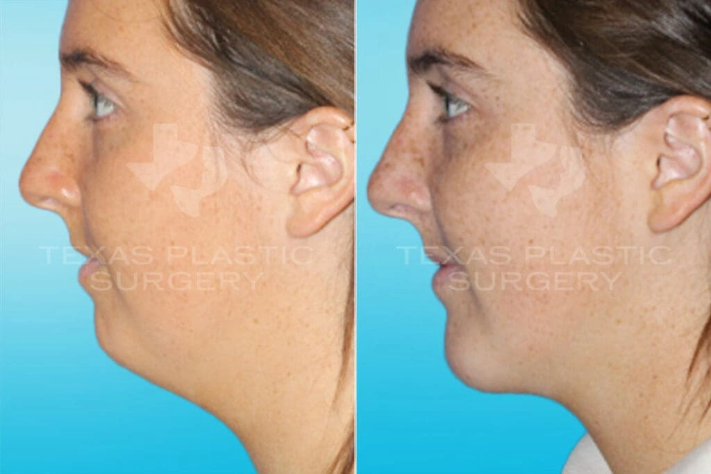 Real Patient results in San Antonio, TX Performed by Texas Plastic Surgery