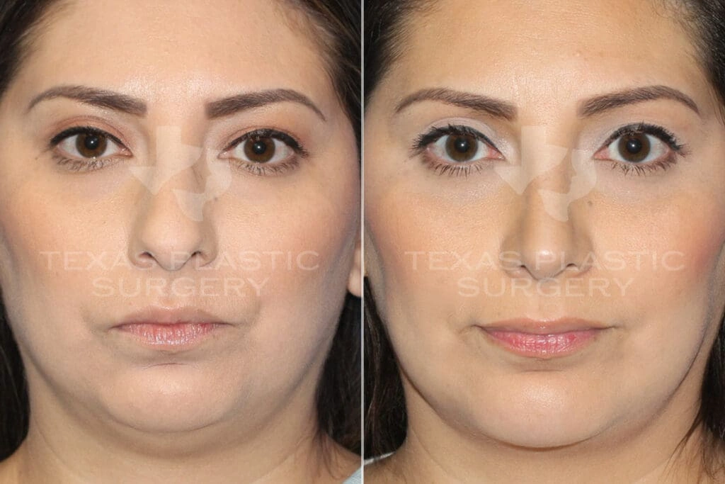 Real Patient results in San Antonio, TX Performed by Texas Plastic Surgery