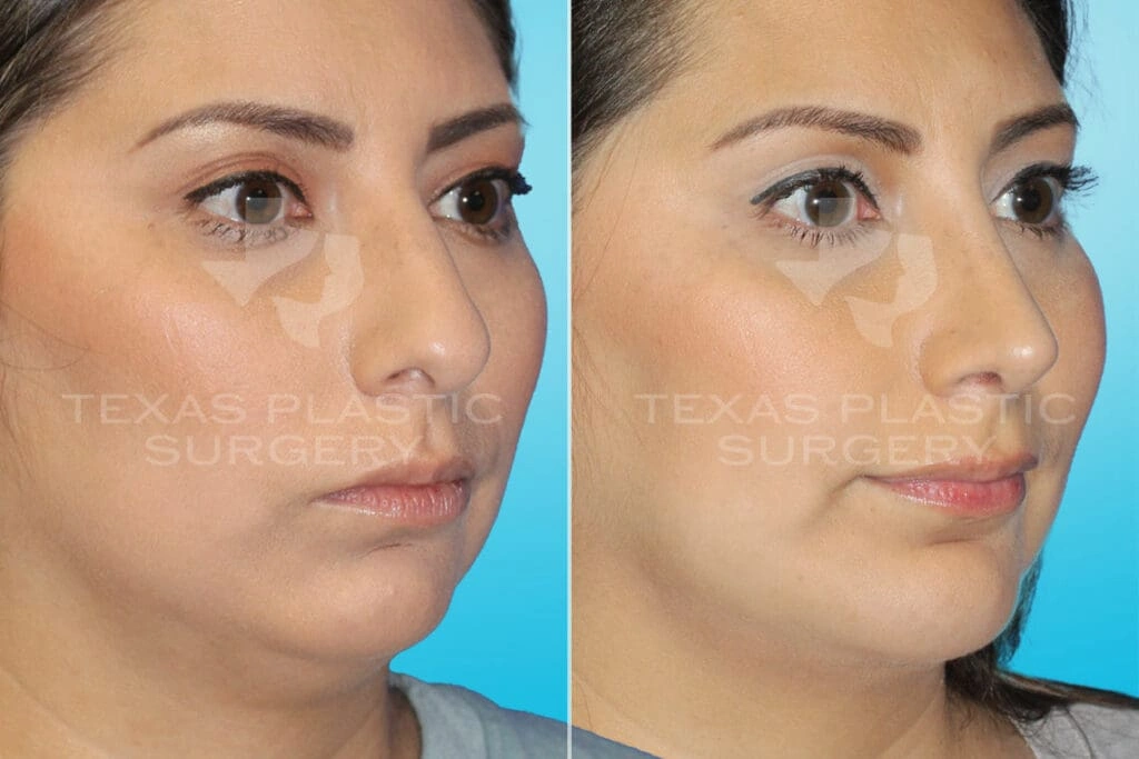 Real Patient results in San Antonio, TX Performed by Texas Plastic Surgery