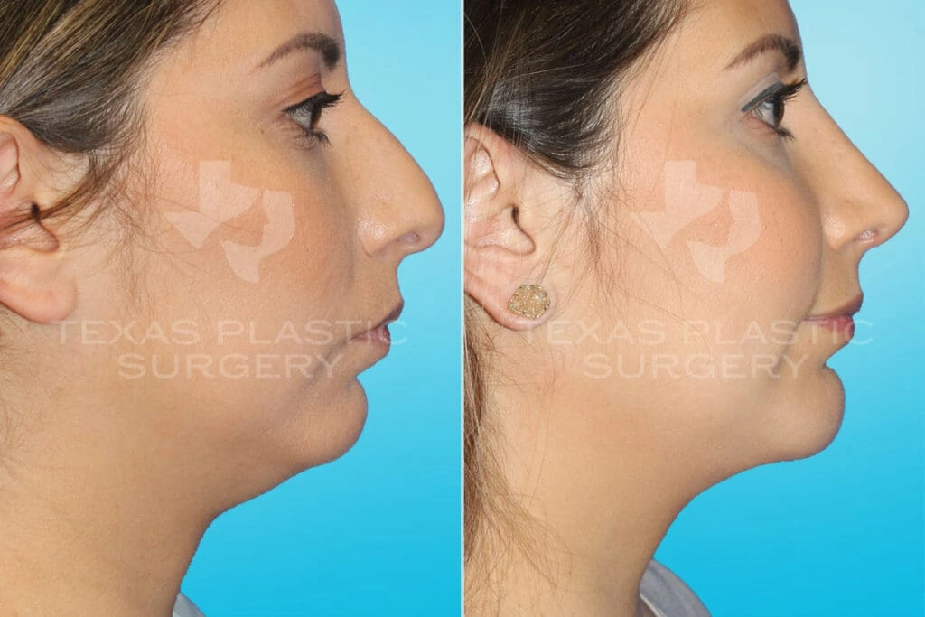 Real Patient results in San Antonio, TX Performed by Texas Plastic Surgery