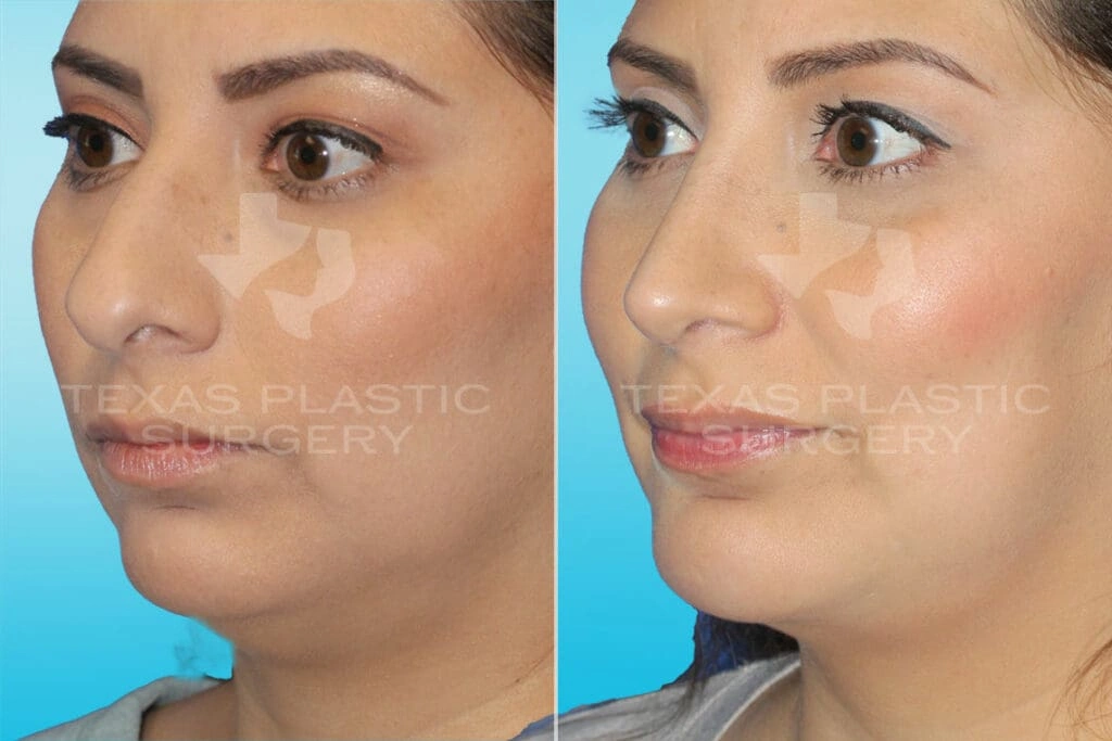 Real Patient results in San Antonio, TX Performed by Texas Plastic Surgery