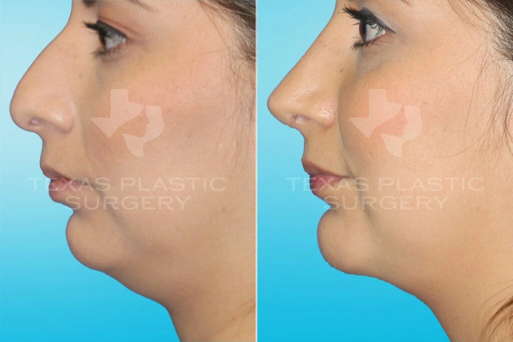 Real Patient results in San Antonio, TX Performed by Texas Plastic Surgery
