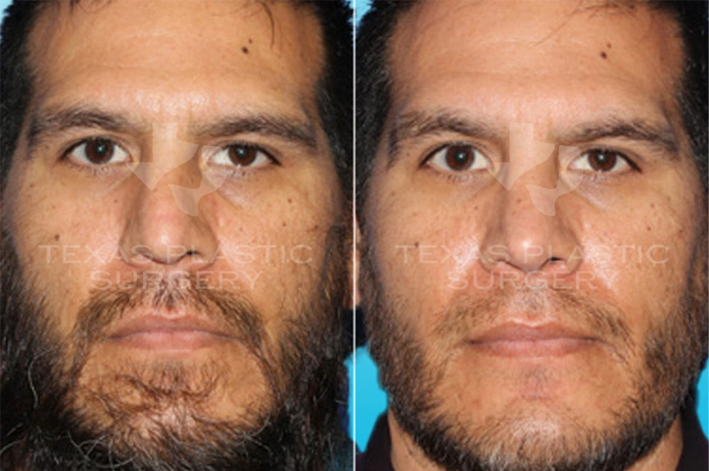 Real Patient results in San Antonio, TX Performed by Texas Plastic Surgery