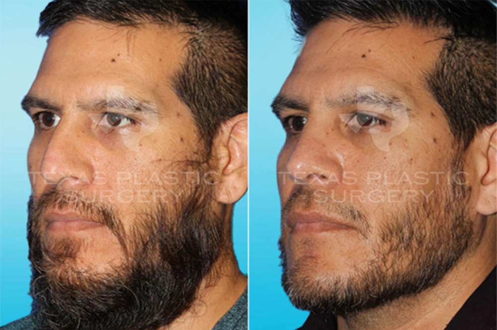 Real Patient results in San Antonio, TX Performed by Texas Plastic Surgery