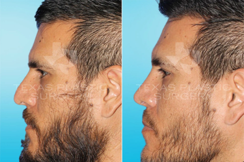 Real Patient results in San Antonio, TX Performed by Texas Plastic Surgery