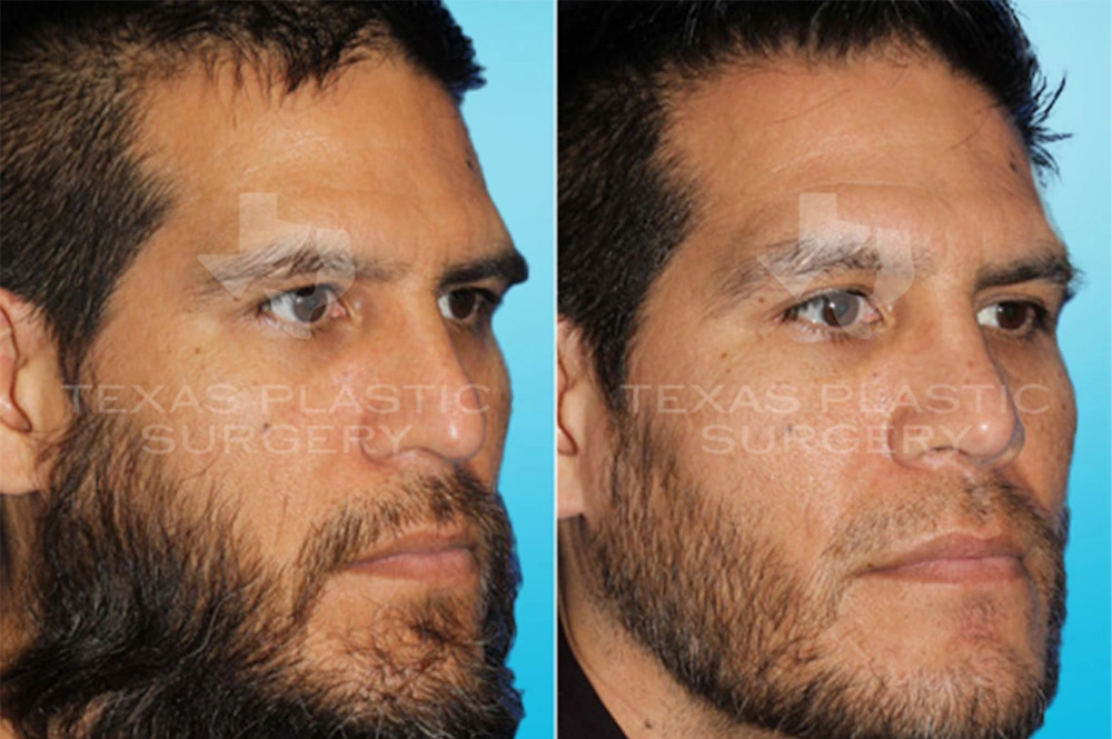 Real Patient results in San Antonio, TX Performed by Texas Plastic Surgery