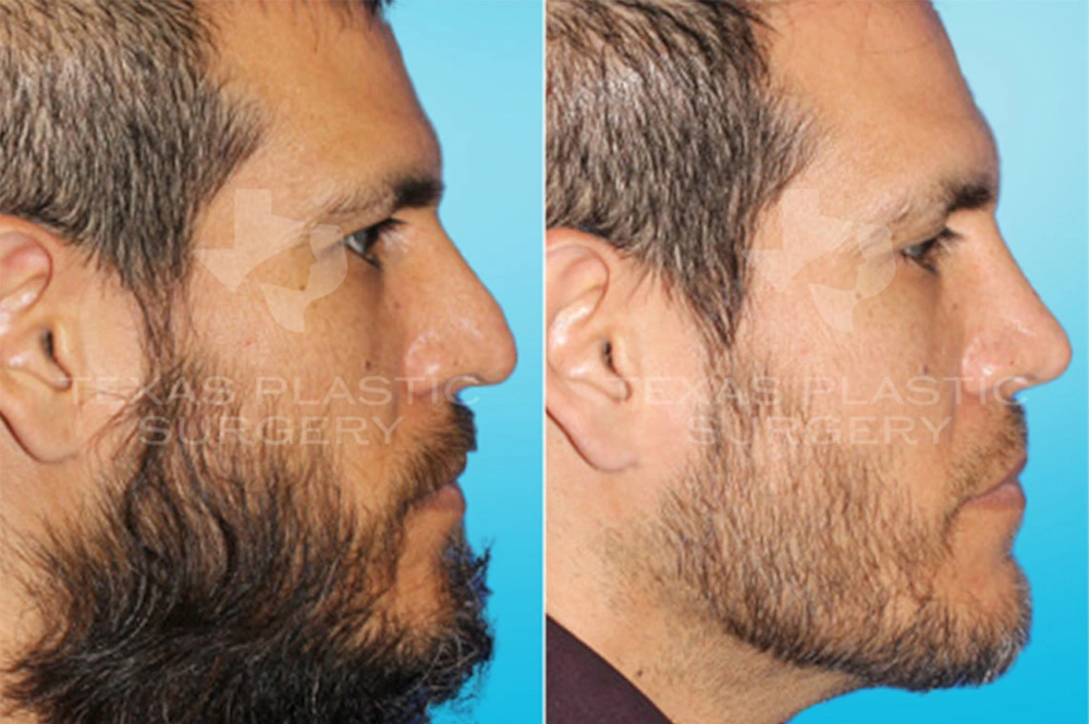 Real Patient results in San Antonio, TX Performed by Texas Plastic Surgery