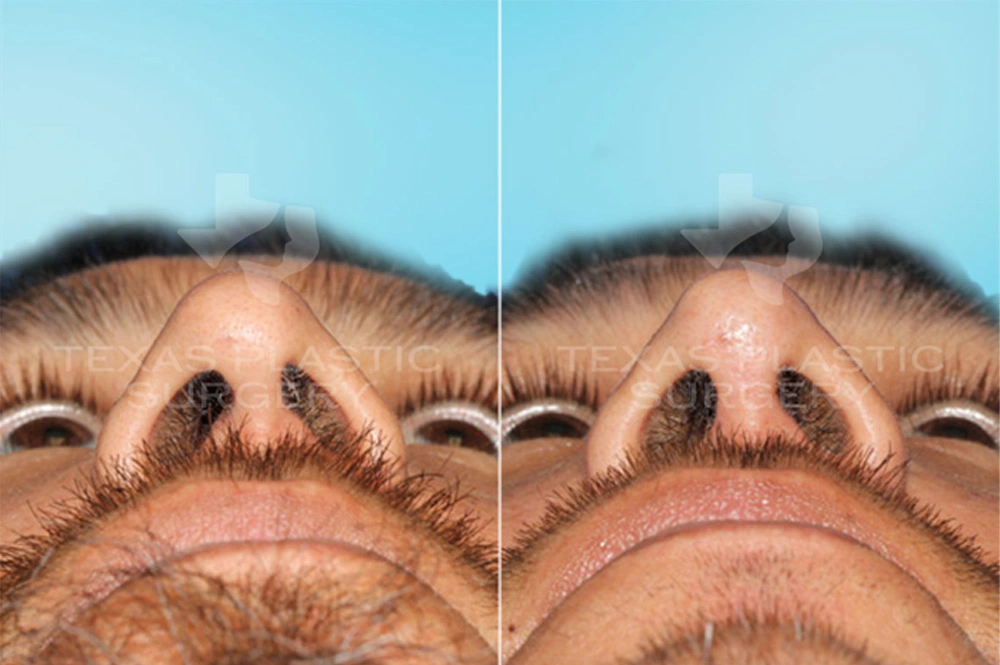 Real Patient results in San Antonio, TX Performed by Texas Plastic Surgery
