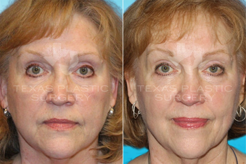 Real Patient results in San Antonio, TX Performed by Texas Plastic Surgery