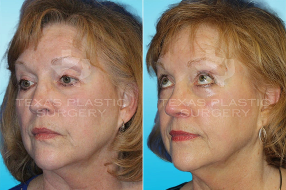 Real Patient results in San Antonio, TX Performed by Texas Plastic Surgery