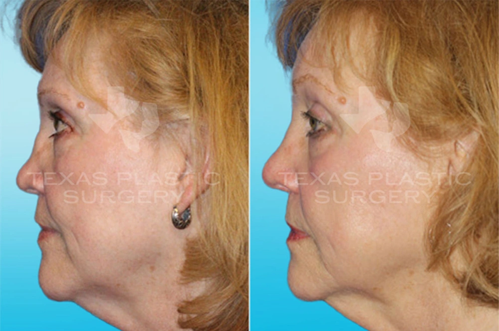 Real Patient results in San Antonio, TX Performed by Texas Plastic Surgery