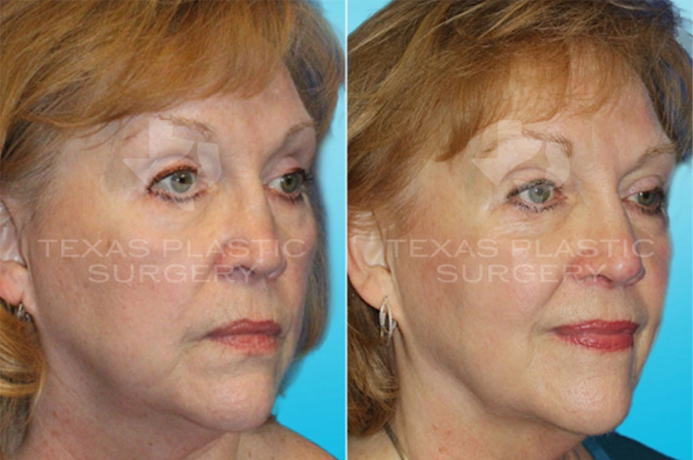 Real Patient results in San Antonio, TX Performed by Texas Plastic Surgery