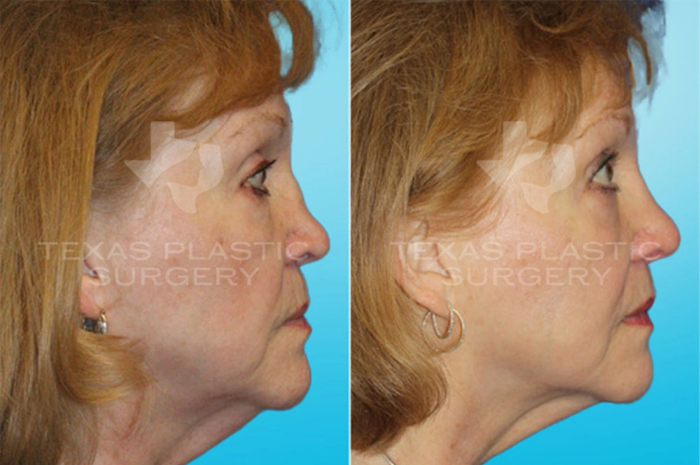 Real Patient results in San Antonio, TX Performed by Texas Plastic Surgery