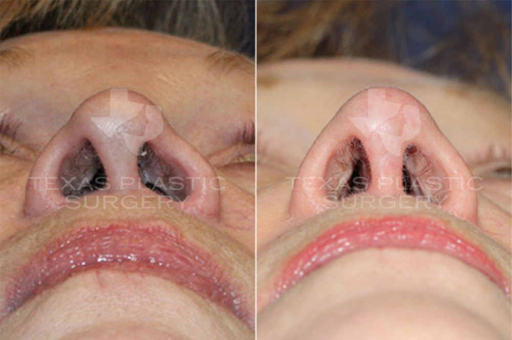 Real Patient results in San Antonio, TX Performed by Texas Plastic Surgery