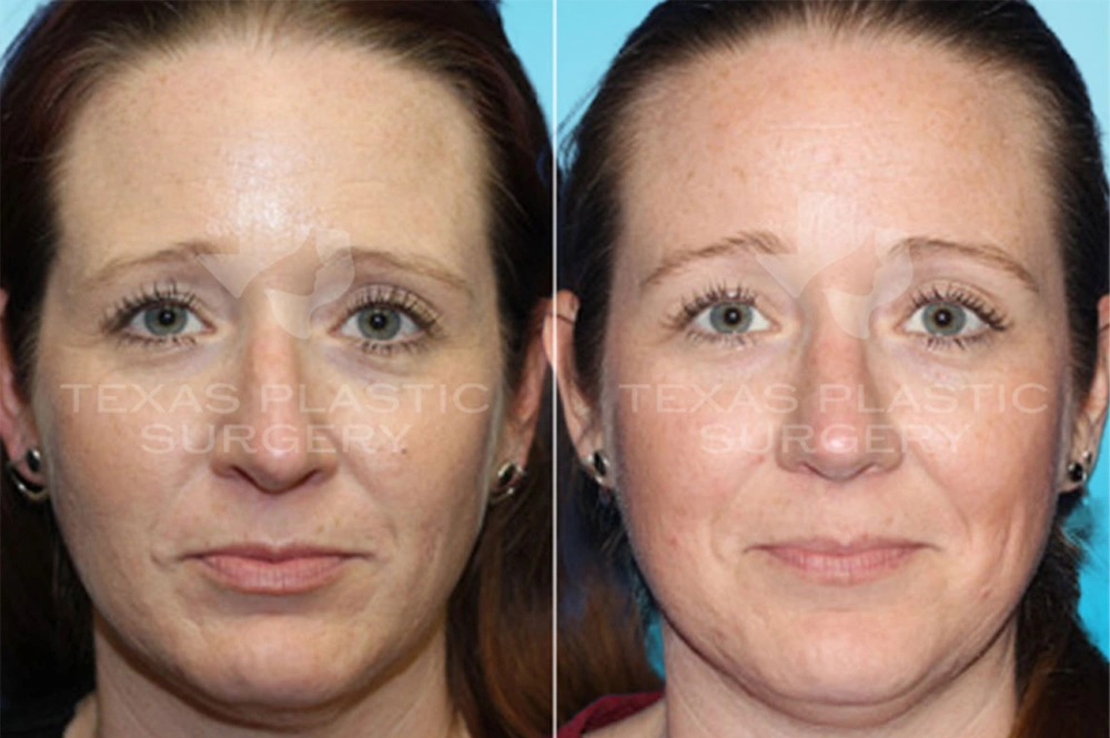 Real Patient results in San Antonio, TX Performed by Texas Plastic Surgery