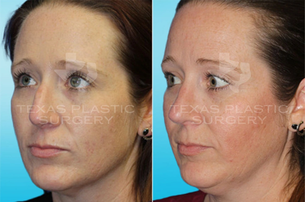 Real Patient results in San Antonio, TX Performed by Texas Plastic Surgery