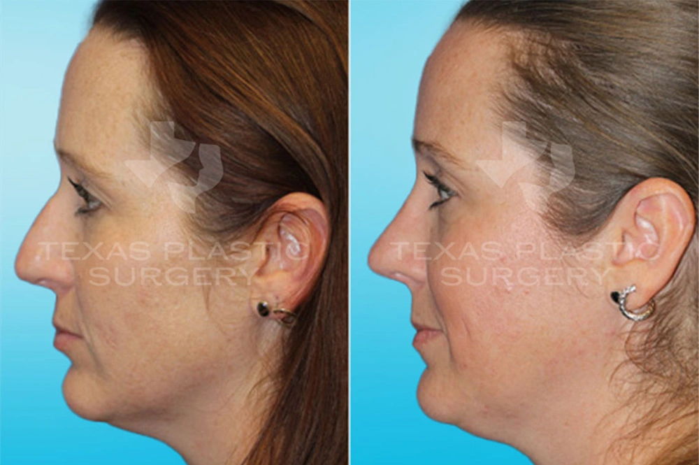 Real Patient results in San Antonio, TX Performed by Texas Plastic Surgery