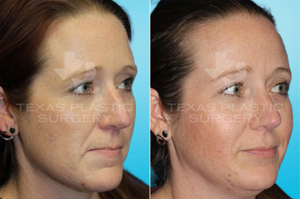 Real Patient results in San Antonio, TX Performed by Texas Plastic Surgery