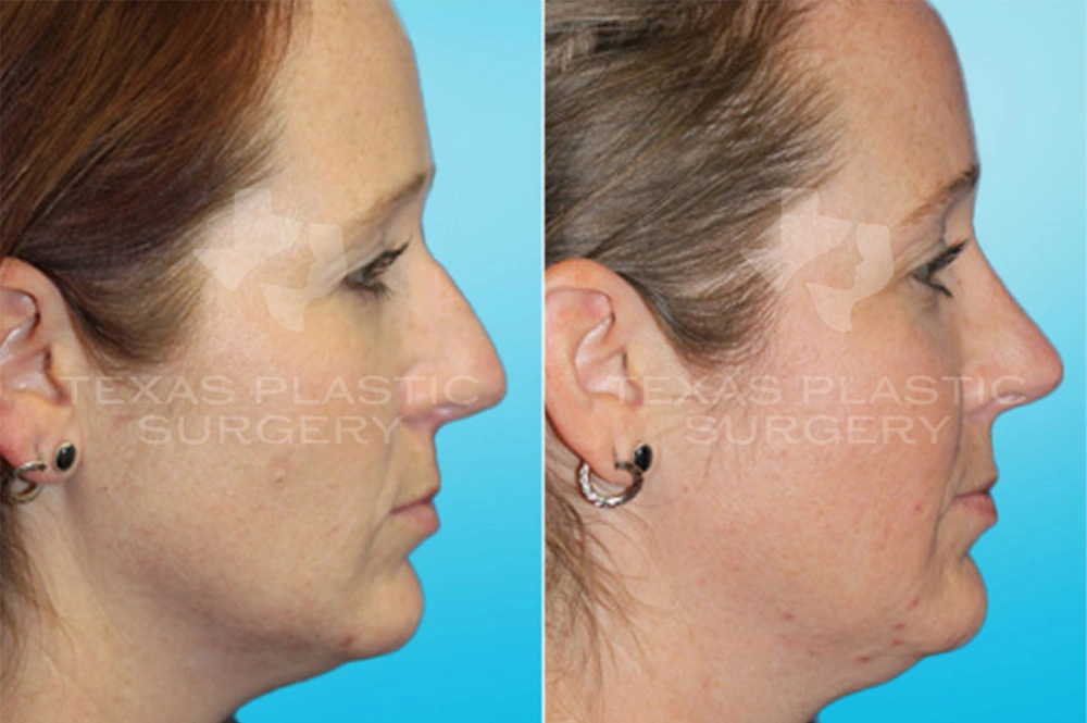 Real Patient results in San Antonio, TX Performed by Texas Plastic Surgery