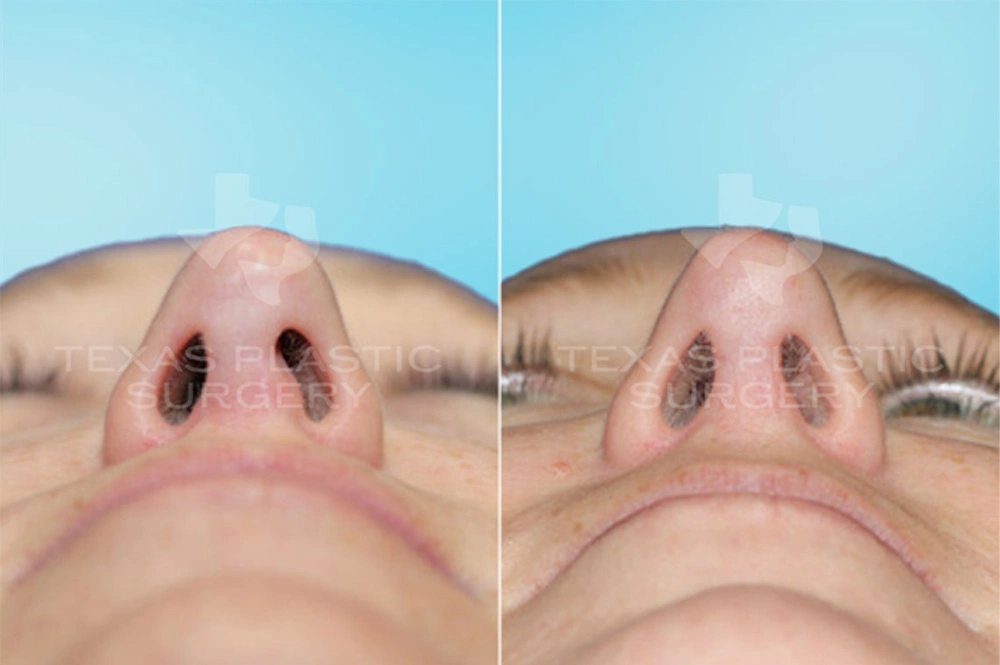 Real Patient results in San Antonio, TX Performed by Texas Plastic Surgery