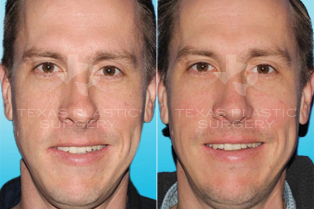 Real Patient results in San Antonio, TX Performed by Texas Plastic Surgery