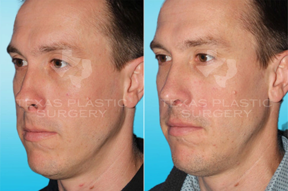 Real Patient results in San Antonio, TX Performed by Texas Plastic Surgery