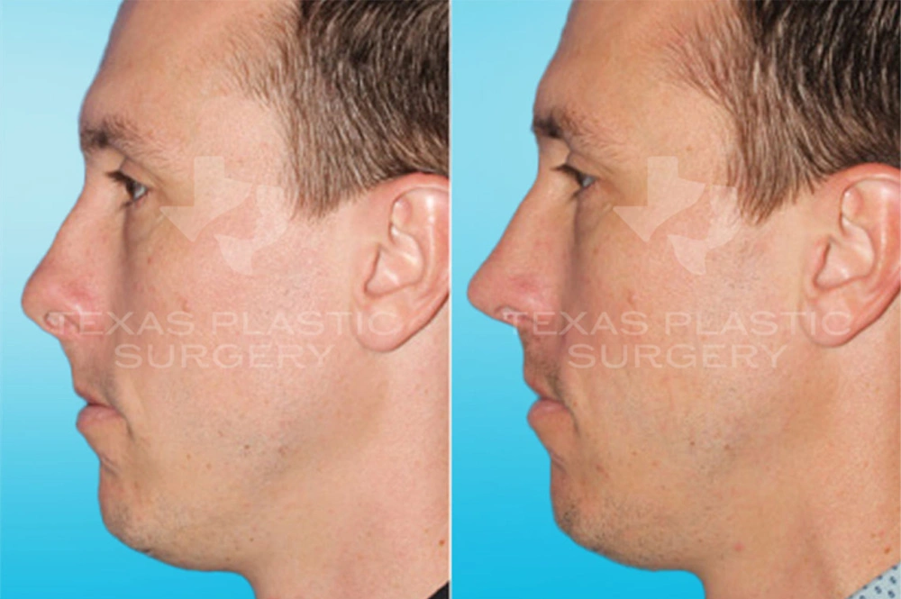 Real Patient results in San Antonio, TX Performed by Texas Plastic Surgery