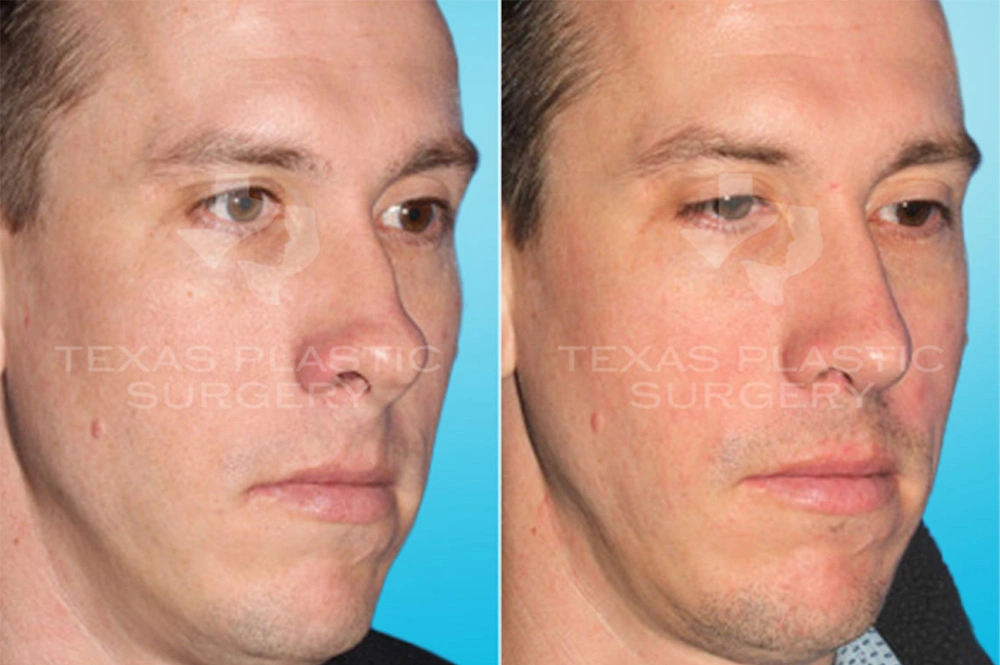 Real Patient results in San Antonio, TX Performed by Texas Plastic Surgery