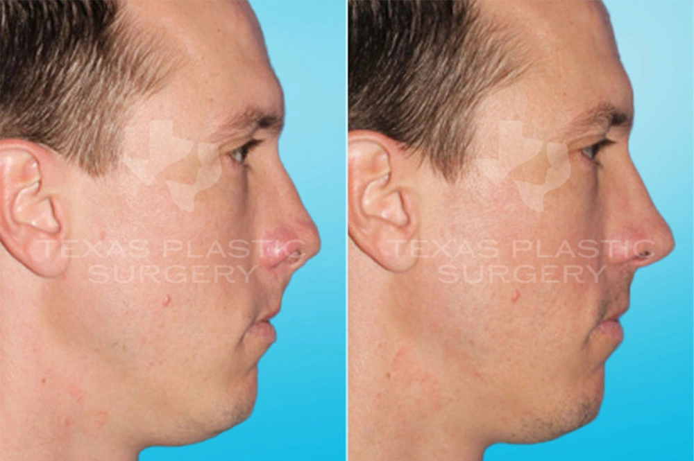 Real Patient results in San Antonio, TX Performed by Texas Plastic Surgery