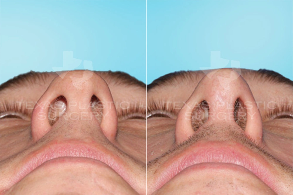 Real Patient results in San Antonio, TX Performed by Texas Plastic Surgery