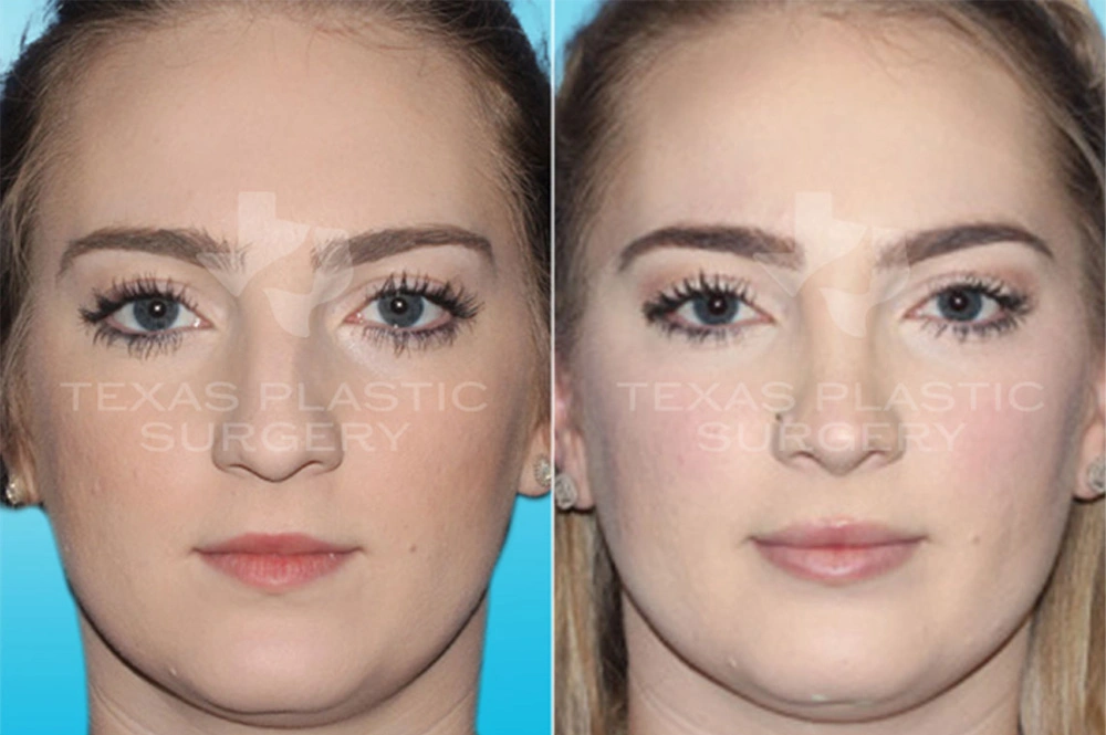 Real Patient results in San Antonio, TX Performed by Texas Plastic Surgery