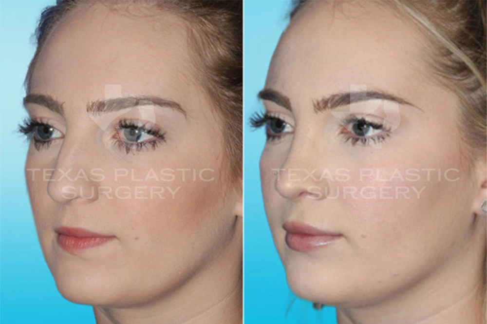 Real Patient results in San Antonio, TX Performed by Texas Plastic Surgery