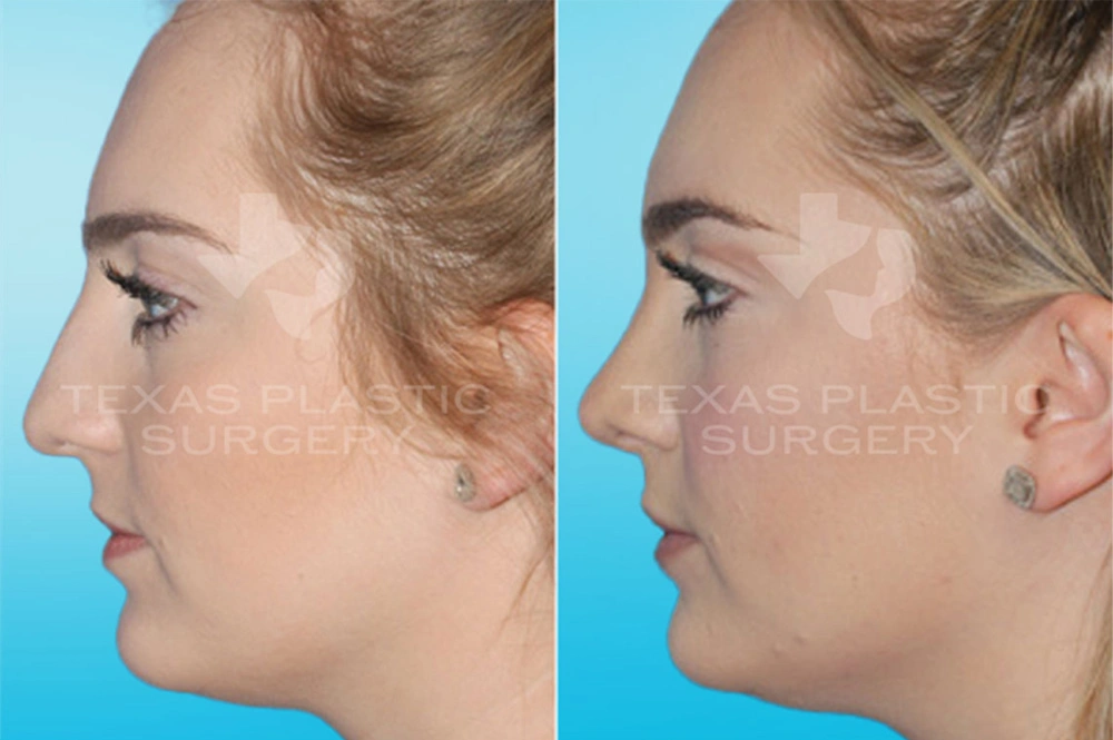 Real Patient results in San Antonio, TX Performed by Texas Plastic Surgery