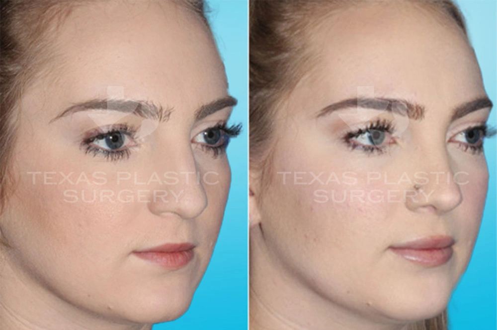 Real Patient results in San Antonio, TX Performed by Texas Plastic Surgery