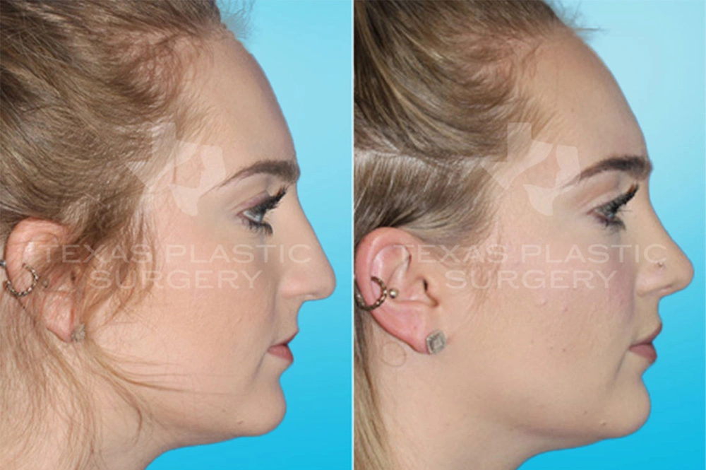 Real Patient results in San Antonio, TX Performed by Texas Plastic Surgery