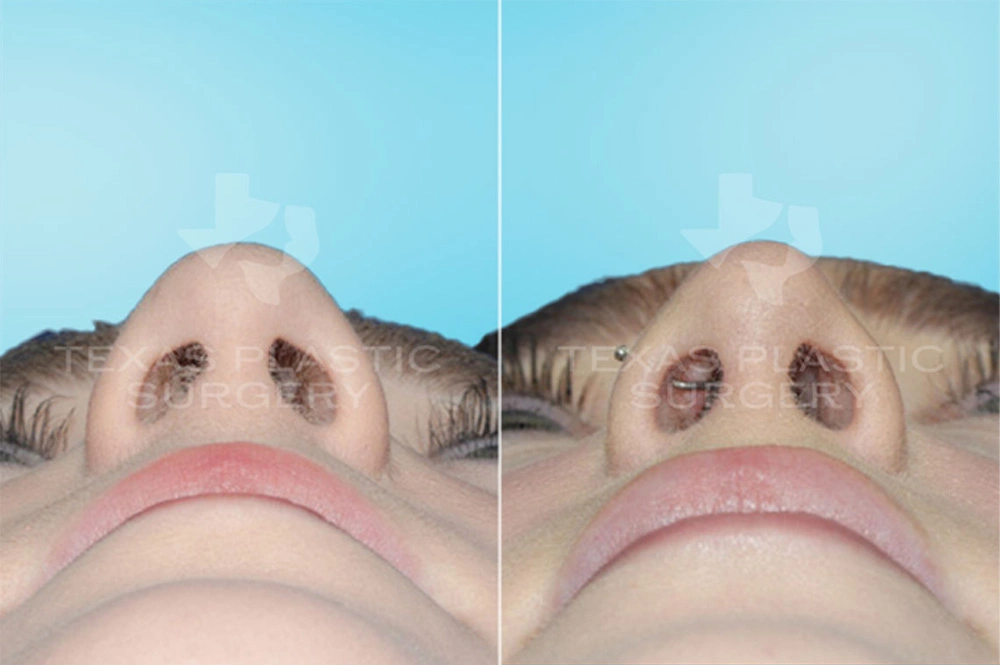 Real Patient results in San Antonio, TX Performed by Texas Plastic Surgery