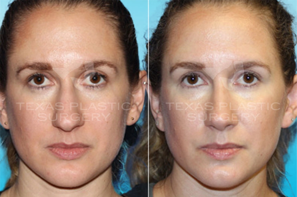 Real Patient results in San Antonio, TX Performed by Texas Plastic Surgery