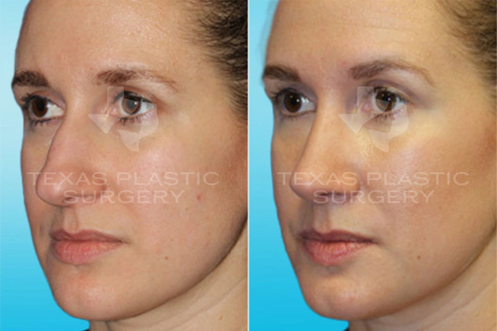 Real Patient results in San Antonio, TX Performed by Texas Plastic Surgery