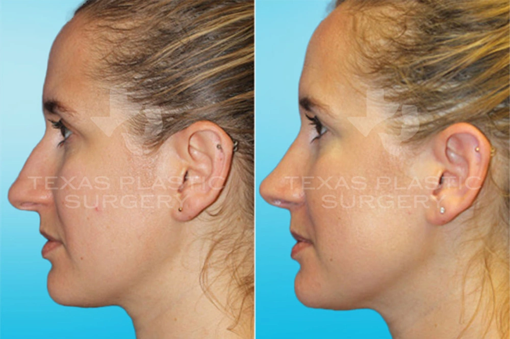 Real Patient results in San Antonio, TX Performed by Texas Plastic Surgery