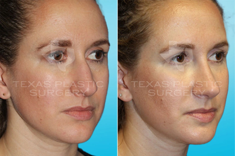 Real Patient results in San Antonio, TX Performed by Texas Plastic Surgery