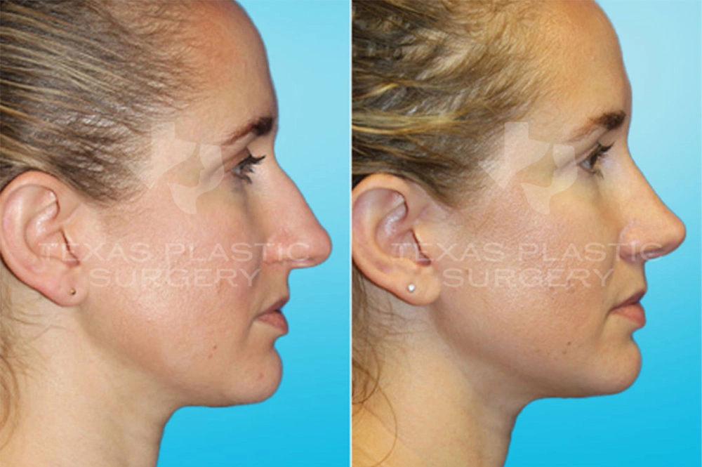 Real Patient results in San Antonio, TX Performed by Texas Plastic Surgery