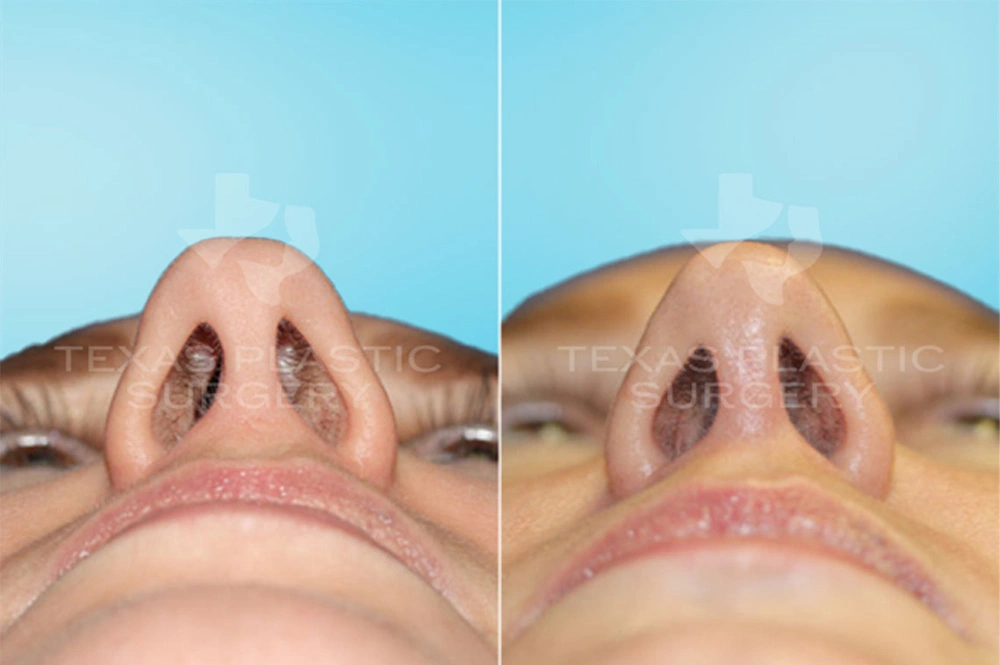 Real Patient results in San Antonio, TX Performed by Texas Plastic Surgery